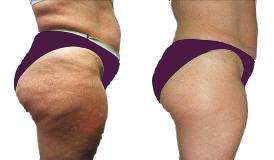 Lose lots of cms with our Self-Heating Cellulite/Slimming Bodywrap!!!